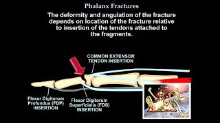 Phalanx Fractures  Everything You Need To Know  Dr Nabil Ebraheim [upl. by Lorraine]