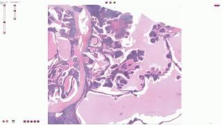 Warthin Tumor  Histopathology [upl. by Ahsined322]