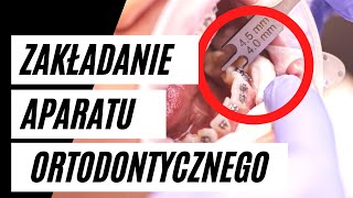 Zakładanie aparatu ortodontycznego  krok po kroku  VLOG3 [upl. by Basset]