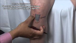 Knee Injection  Anterior Approach [upl. by Leugar]