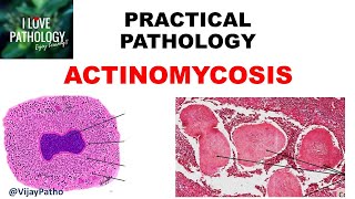 Practical Pathology ACTINOMYCOSIS [upl. by Edge738]