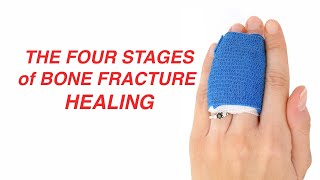 The Four Stages of Bone Fracture Healing [upl. by Aehtela683]