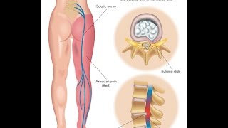 What is Sciatica [upl. by Nisior]