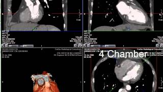 Coronary CT Angiography RCA Stenosis [upl. by Tsenrae256]