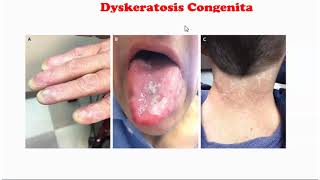 Dyskeratosis Congenita [upl. by Schlessinger675]