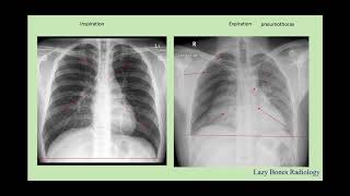 Body Cavities abdominal divisions and body habitus episode 3 LazyBonesRadiology [upl. by Yseulte733]