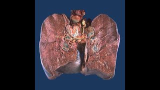 GENERAL PATHOLOGY 28  sarcoidosis DR SAMEH GHAZY [upl. by Arch]