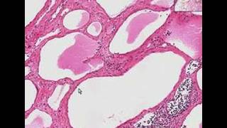 Histopathology NeckLymphangioma cystic hygroma [upl. by Heida]