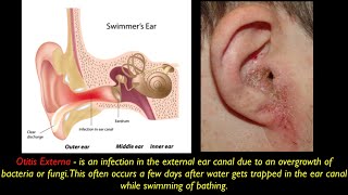 Otitis Externa PEV [upl. by Nnaik]